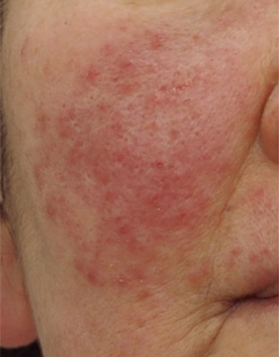 ポテンツァで赤ら顔の治療を行った症例写真,Before,ba_potenza001_b01.jpg