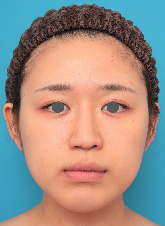 バッカルファット除去,バッカルファット除去を行った20代女性の症例写真,Before,ba_buccalfat022_b01.jpg