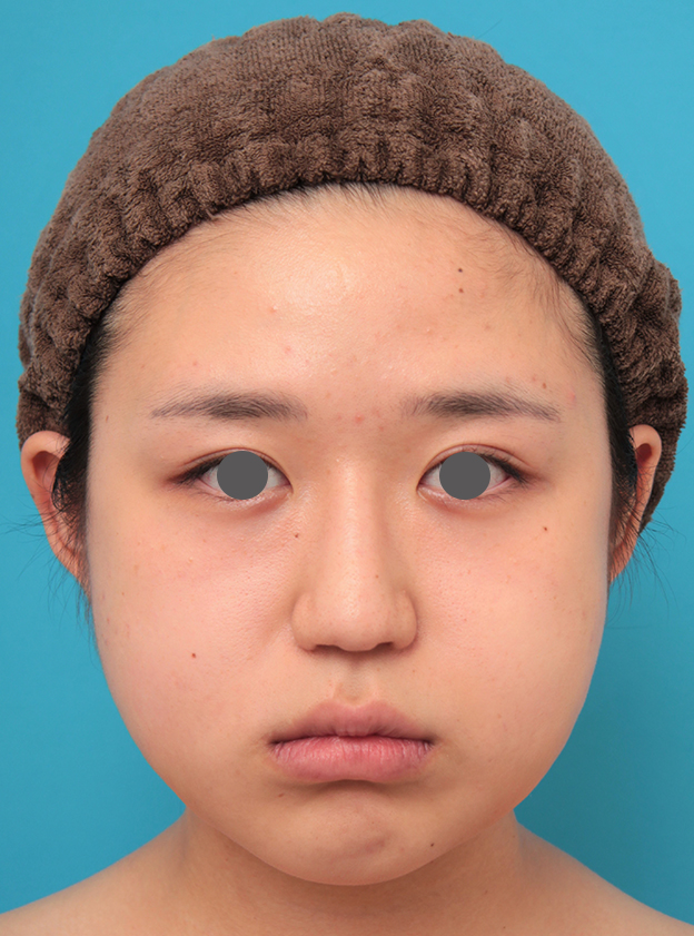 症例写真,バッカルファット除去を行った20代女性の症例写真,手術直後,mainpic_buccalfat022b.jpg