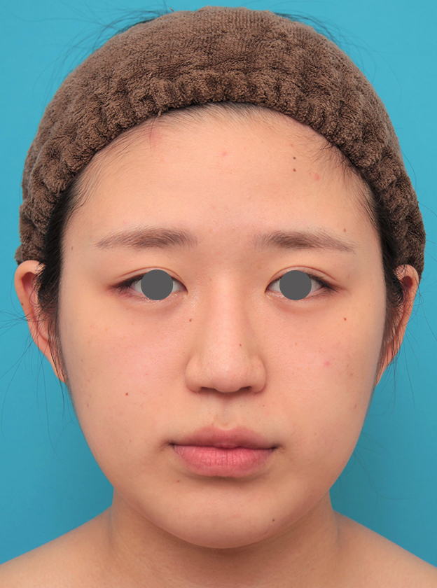 症例写真,バッカルファット除去を行った20代女性の症例写真,6ヶ月後,mainpic_buccalfat022e.jpg