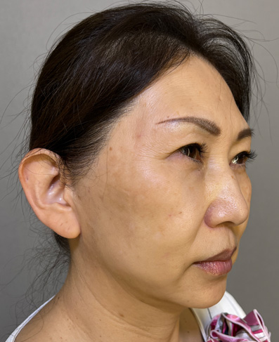 症例写真,1Day Yes!小顔術の施術をした40代女性の症例写真,After,ba_1day_kogao002_b02.jpg