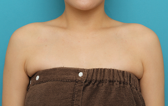 症例写真,肩ボトックス注射で筋肉の盛り上がりをすっきりさせた30代女性の症例写真,After（2ヶ月後）,ba_beautiful_shoulder_botox007_b01.jpg