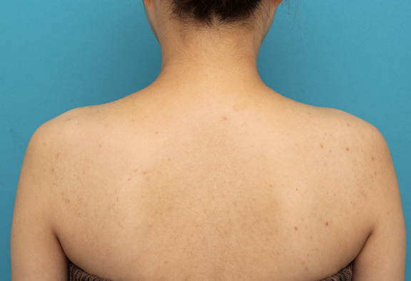 症例写真,肩ボトックス注射で筋肉の盛り上がりをすっきりさせた30代女性の症例写真,After（2ヶ月後）,ba_beautiful_shoulder_botox007_b02.jpg