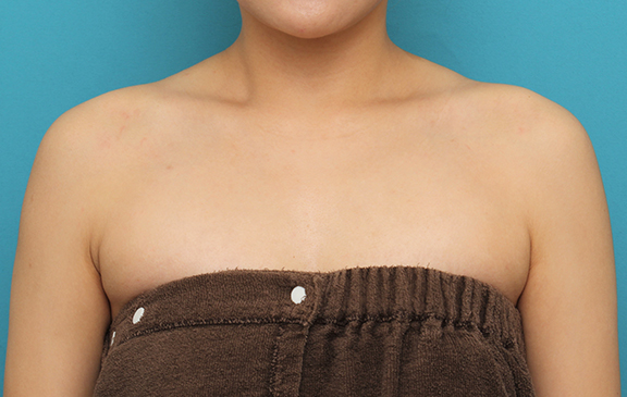 症例写真,肩ボトックス注射で筋肉の盛り上がりをすっきりさせた30代女性の症例写真,Before,ba_beautiful_shoulder_botox007_b01.jpg