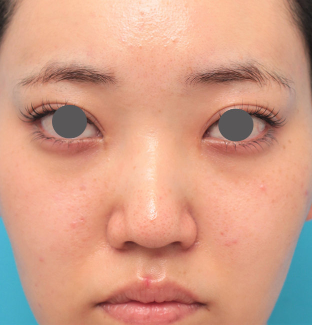 症例写真,鼻筋の長期持続型ヒアルロン酸注射+鼻先の耳介軟骨移植を行った20代女性の症例写真,手術前,mainpic_ryubi2043a.jpg