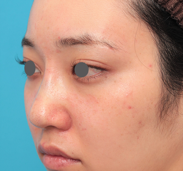 症例写真,鼻筋の長期持続型ヒアルロン酸注射+鼻先の耳介軟骨移植を行った20代女性の症例写真,手術直後,mainpic_ryubi2043f.jpg