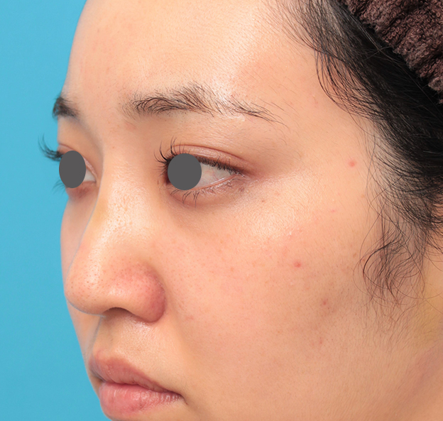 症例写真,鼻筋の長期持続型ヒアルロン酸注射+鼻先の耳介軟骨移植を行った20代女性の症例写真,6日後,mainpic_ryubi2043g.jpg