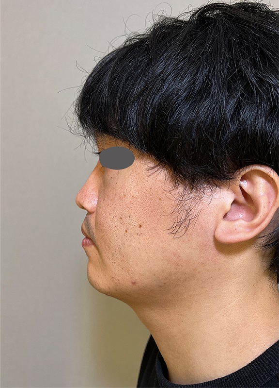 症例写真,耳介軟骨移植で鼻先を高くスマートに整えた症例写真,Before,ba_jikai048_b01.jpg