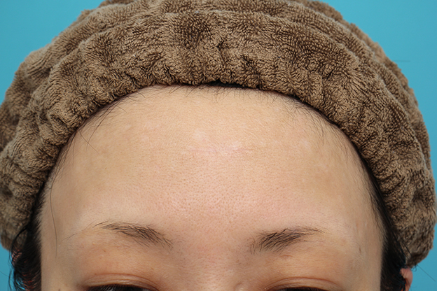 症例写真,額の水疱瘡跡を傷跡修正手術で綺麗にした20代女性の症例写真,2ヶ月後,mainpic_keisei002d.jpg