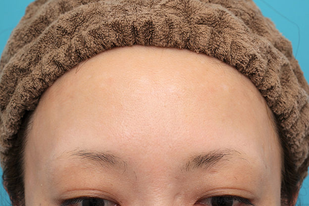 症例写真,額の水疱瘡跡を傷跡修正手術で綺麗にした20代女性の症例写真,6ヶ月後,mainpic_keisei002e.jpg