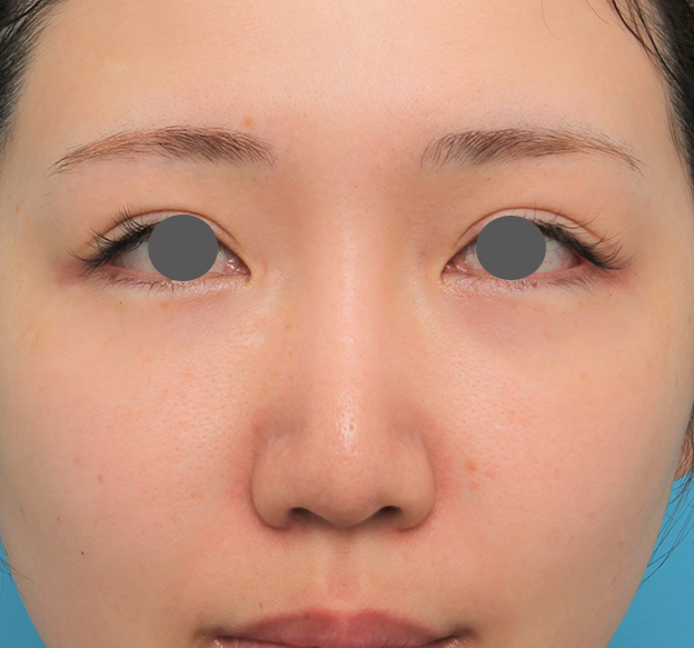 症例写真,鼻プロテーゼ+鼻柱の耳介軟骨移植+小鼻縮小を行った20代女性の症例写真,6ヶ月後,mainpic_ryubi1063e.jpg
