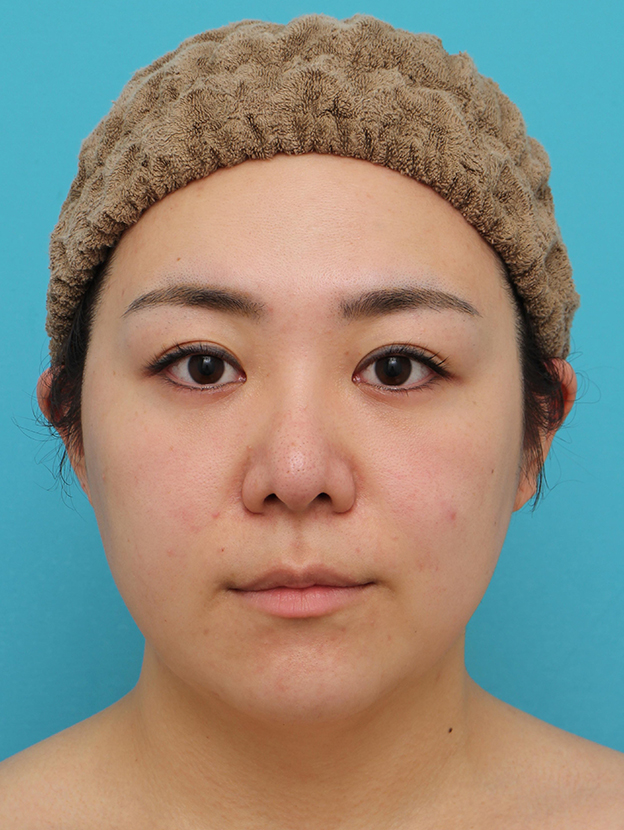 症例写真,頬～フェイスライン～顎下の脂肪吸引をした20代女性の症例写真,3ヶ月後,mainpic_shibokyuin047e.jpg