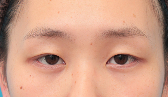 眼瞼下垂手術+目頭切開+目尻切開+グラマラスラインを行った20代女性症例写真,Before,ba_ganken044_b01.jpg
