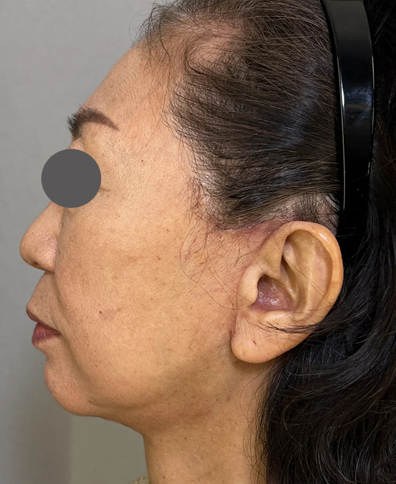 症例写真,ミディアムフェイスリフト＋顎下脂肪吸引＋あごにヒアルロン酸注射をした症例写真,After（1ヶ月後）,ba_facelift007_b02.jpg