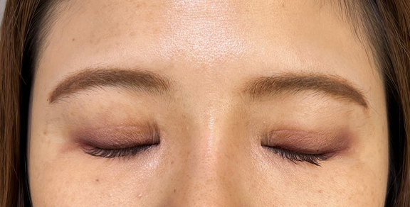 症例写真,二重まぶた切開法で眼瞼下垂手術と同じくらい目をパッチリさせた症例写真,After（目を閉じた状態）<br/>
（3ヶ月後）,