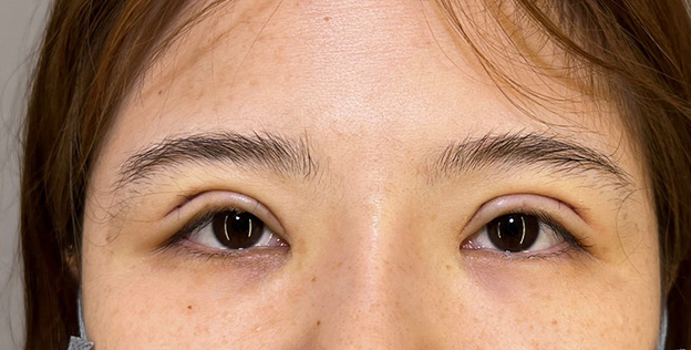 症例写真,二重まぶた切開法で眼瞼下垂手術と同じくらい目をパッチリさせた症例写真,手術直後,目を開けた状態,mainpic_sekkai091b.jpg