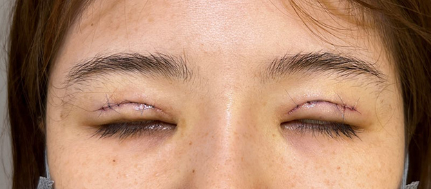 症例写真,二重まぶた切開法で眼瞼下垂手術と同じくらい目をパッチリさせた症例写真,手術直後,目を閉じた状態,mainpic_sekkai091c.jpg