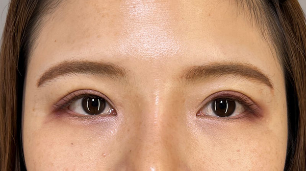 症例写真,二重まぶた切開法で眼瞼下垂手術と同じくらい目をパッチリさせた症例写真,3ヶ月後,目を開けた状態,mainpic_sekkai091d.jpg