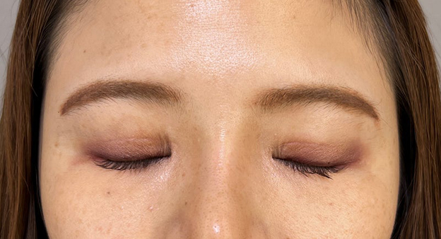 症例写真,二重まぶた切開法で眼瞼下垂手術と同じくらい目をパッチリさせた症例写真,3ヶ月後,目を閉じた状態,mainpic_sekkai091e.jpg