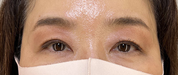 症例写真,埋没法で作った二重を全切開法で固定した症例写真,3ヶ月後,メイクあり,mainpic_sekkai093c.jpg