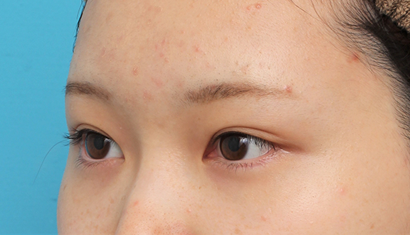 症例写真,グラマラスライン（垂れ目形成手術）を行った20代女性の症例写真,After（6ヶ月後）,ba_panda023_b03.jpg