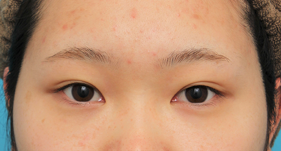 症例写真,グラマラスライン（垂れ目形成手術）を行った20代女性の症例写真,Before,ba_panda023_b01.jpg