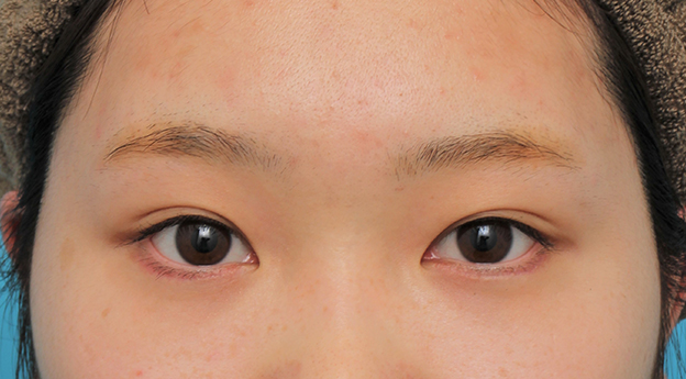 症例写真,グラマラスライン（垂れ目形成手術）を行った20代女性の症例写真,3週間後,mainpic_panda023d.jpg