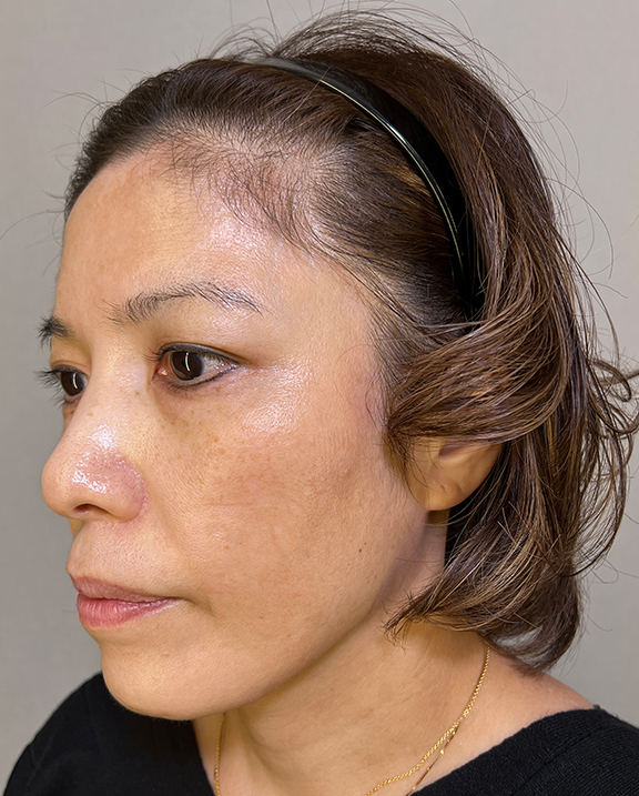 症例写真,イタリアンリフト+イタリアンリフトファイン+顎ボトックス注射を行った40代女性の症例写真,After,ba_italian034_b02.jpg