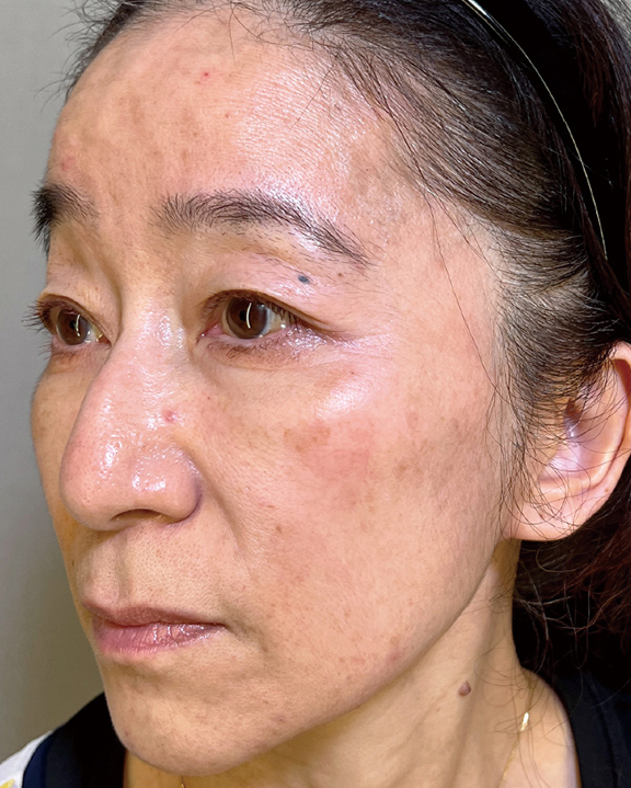 症例写真,しわ取りボトックスとヒアルロン酸を行った女性の症例写真,After(2週間後),ba_botox018_b01.jpg