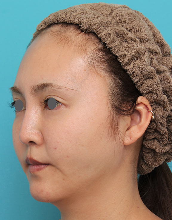 頬骨切り／削り,頬骨削りを行った30代女性の症例写真,After（6ヶ月後）,ba_hohobone002_b02.jpg