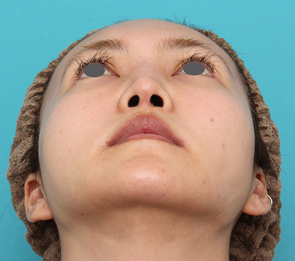 頬骨切り／削り,頬骨削りを行った30代女性の症例写真,After（6ヶ月後）,ba_hohobone002_b03.jpg
