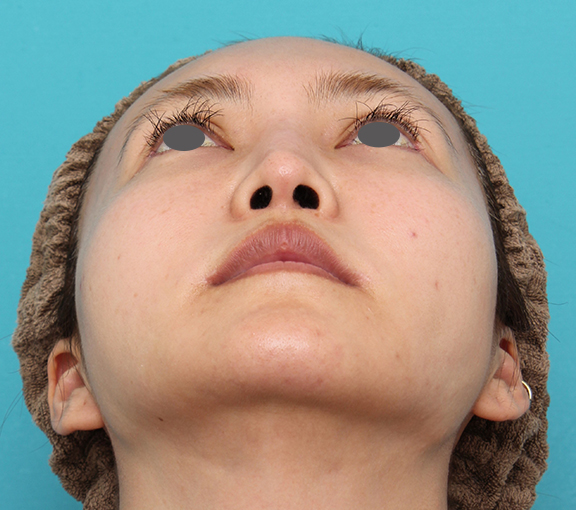 症例写真,頬骨削りを行った30代女性の症例写真,After(6ヶ月後),ba_hohobone002_b03.jpg