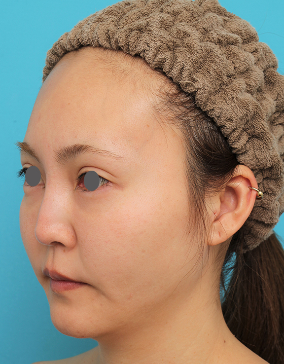 症例写真,頬骨削りを行った30代女性の症例写真,Before,ba_hohobone002_b02.jpg