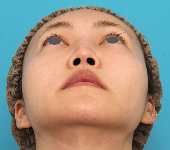 症例写真,頬骨削りを行った30代女性の症例写真,Before,ba_hohobone002_b03.jpg