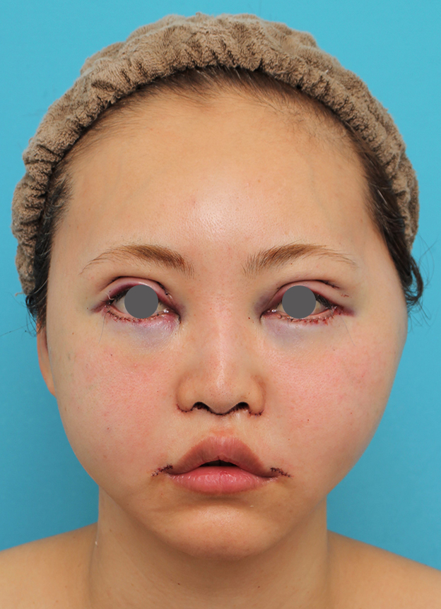 症例写真,頬骨削りを行った30代女性の症例写真,手術直後,mainpic_hohobone002b.jpg