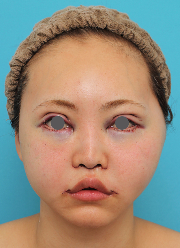 症例写真,頬骨削りを行った30代女性の症例写真,手術直後,mainpic_hohobone002b.jpg
