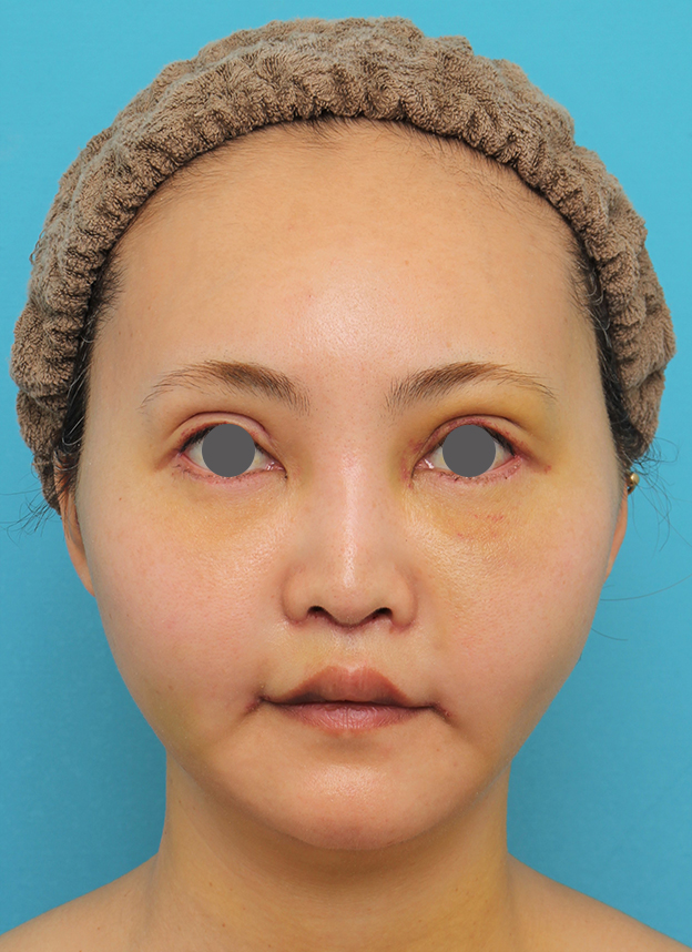 頬骨切り／削り,頬骨削りを行った30代女性の症例写真,6日後,mainpic_hohobone002c.jpg