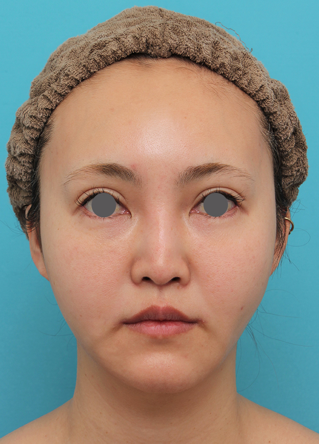 症例写真,頬骨削りを行った30代女性の症例写真,2ヶ月後,mainpic_hohobone002e.jpg