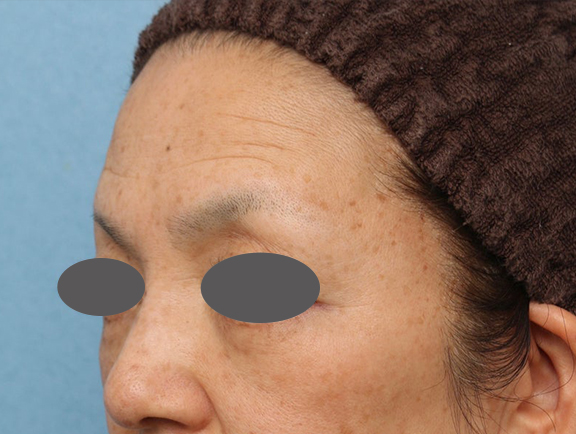 症例写真,こめかみへのヒアルロン酸注入＋肌へのフォトフェイシャルM22を行った症例写真,After（1ヶ月後）,ba_komekami_001_b02.jpg