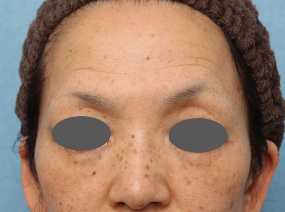 こめかみへのヒアルロン酸注入＋肌へのフォトフェイシャルM22を行った症例写真,Before,ba_komekami_001_b01.jpg