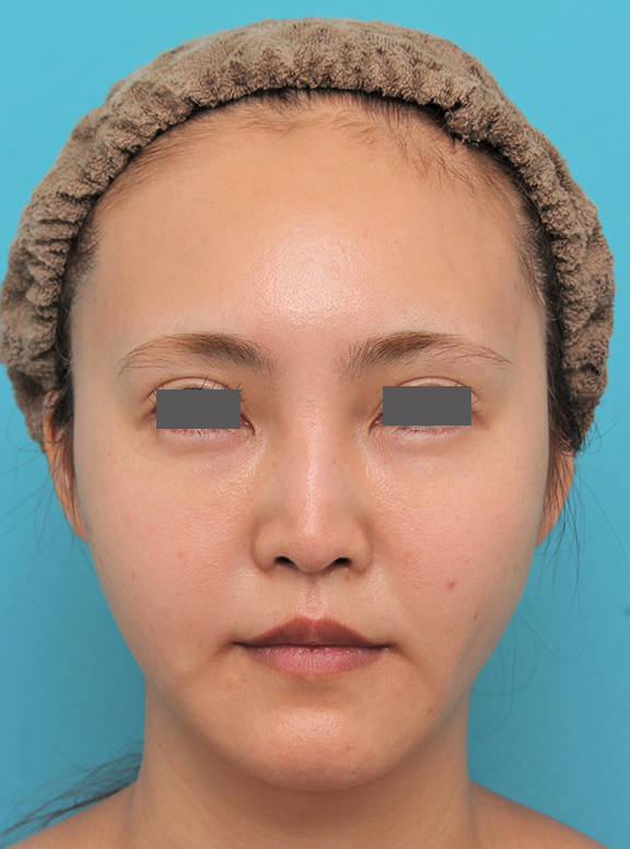 症例写真,人中短縮+口角挙上+小鼻縮小を行った30代女性症例写真,After（6ヶ月後）,ba_hanashita009_b01.jpg