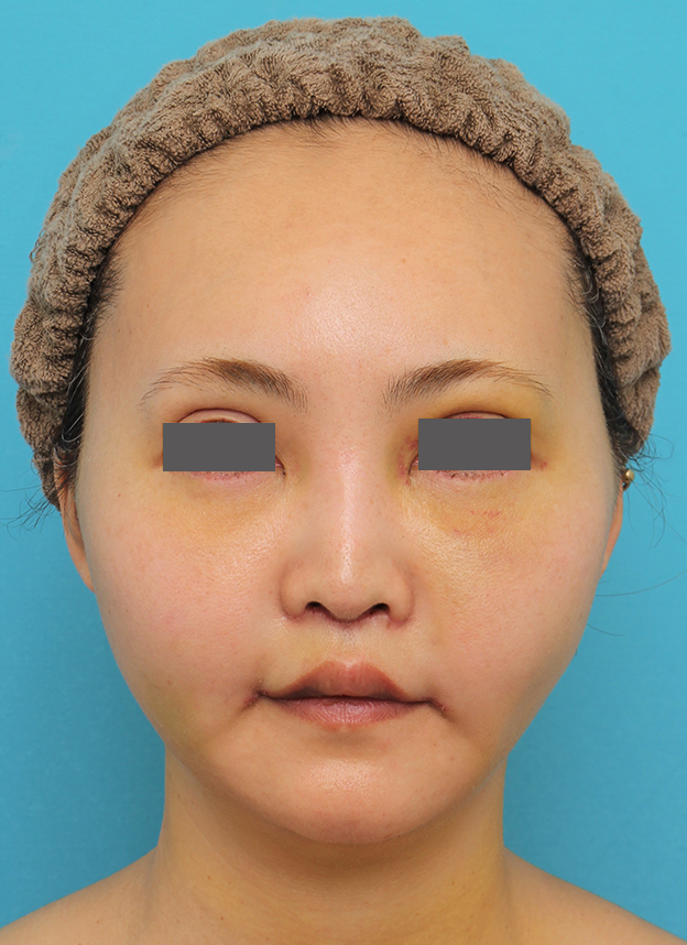 症例写真,人中短縮+口角挙上+小鼻縮小を行った30代女性症例写真,6日後,mainpic_hanashita009c.jpg