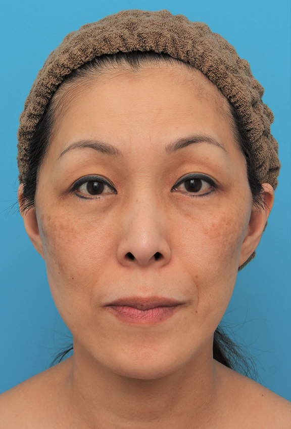 症例写真,ミディアムフェイスリフトを行った50代女性の症例写真,After（6ヶ月後）,ba_mediumlift022_b01.jpg