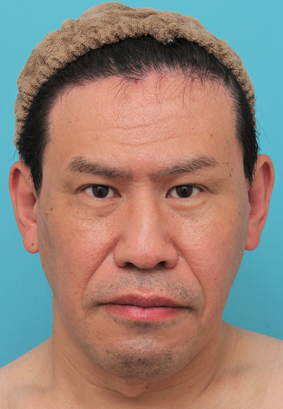 症例写真,額の切開リフトを行った40代男性の症例写真,After（6ヶ月後）,ba_hitailift004_b01.jpg