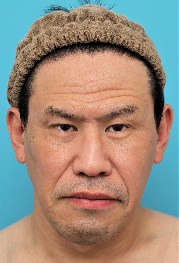 症例写真,額の切開リフトを行った40代男性の症例写真,手術前,mainpic_hitailift004a.jpg