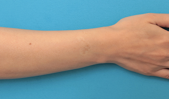根性焼きの傷跡を手術で切除縫合し1本の傷にした症例写真,Before,ba_wrist002_b01.jpg