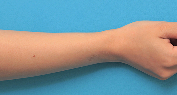 症例写真,根性焼きの傷跡を手術で切除縫合し1本の傷にした症例写真,Before,ba_wrist002_b02.jpg