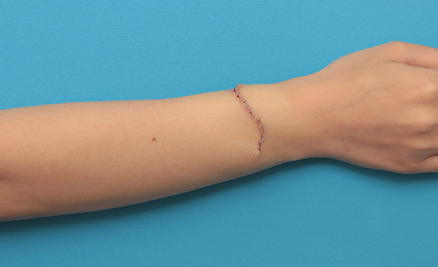 症例写真,根性焼きの傷跡を手術で切除縫合し1本の傷にした症例写真,手術直後,mainpic_wrist002b.jpg