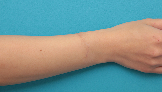 症例写真,根性焼きの傷跡を手術で切除縫合し1本の傷にした症例写真,3ヶ月後,mainpic_wrist002e.jpg