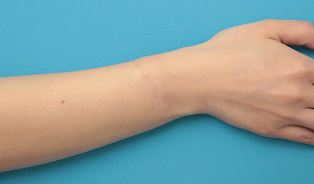 症例写真,根性焼きの傷跡を手術で切除縫合し1本の傷にした症例写真,6ヶ月後,mainpic_wrist002f.jpg